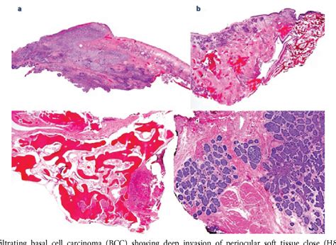 Figure 1 From Advanced Periocular Basal Cell Carcinoma With Orbital Invasion Update On