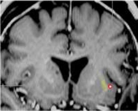 Electrical Stimulation of the Claustrum for Treatment of Epilepsy - 013 ...