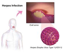 Herpes - Wikipedia