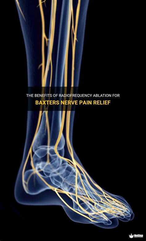 The Benefits Of Radiofrequency Ablation For Baxters Nerve Pain Relief | MedShun