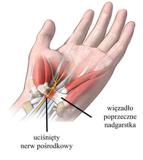 Zesp Cie Ni Nadgarstka Czy Zawsze Potrzebna Jest Operacja