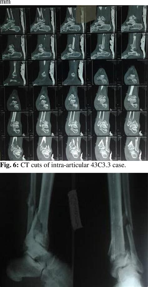 Figure 1 From Management Of Distal Tibial Fractures By Ilizarov Fixator