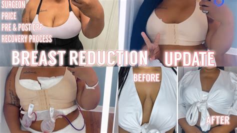 Breast Reduction Update Breast Reduction Lift 3 Weeks Post Op