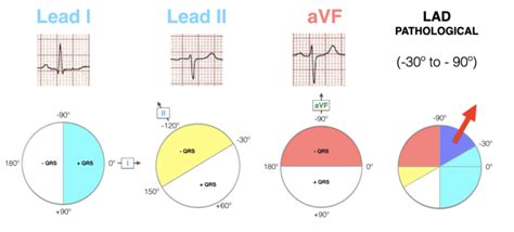 Ecg Axis Interpretation Litfl Ecg Library Basics