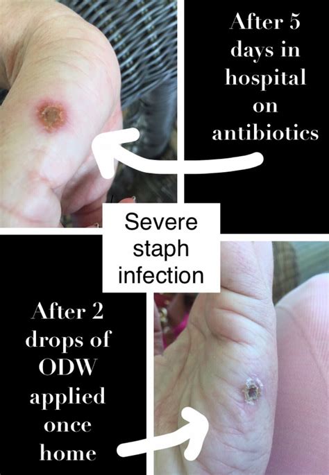 Stages Of Staph Infection