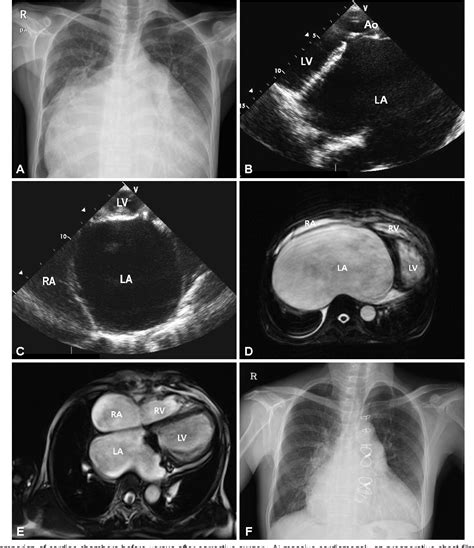 Figure 1 From A Giant Left Atrium In Rheumatic Mitral Stenosis