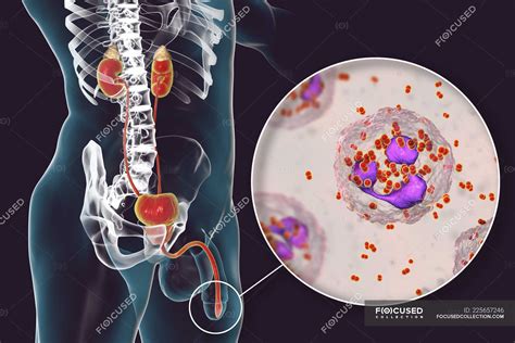 Gonorrea causas síntomas y tratamiento