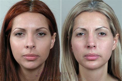 Cheek Chin Implants Before And After Pictures Case Paramus New