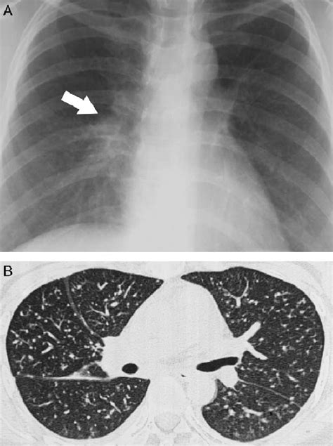 Miliary Tuberculosis In A 31 Year Old Female Who Underwent Allogeneic Download Scientific