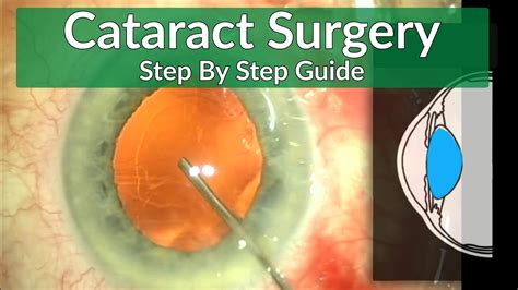 Cataract Surgery Teaching A Beginner S Guide Youtube