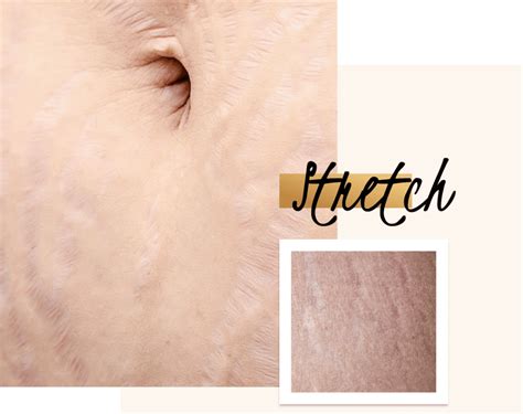 Ipl Laser Stretch Marks Treatment At Define Medical Clinic Beaconsfield