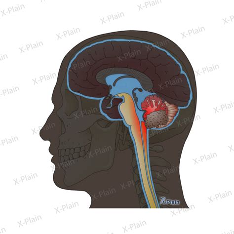 Brain Tumor CSF Blocked Pressure