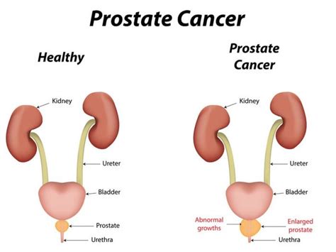 Learn About Prostate Cancer Screening Paramount Lifecare