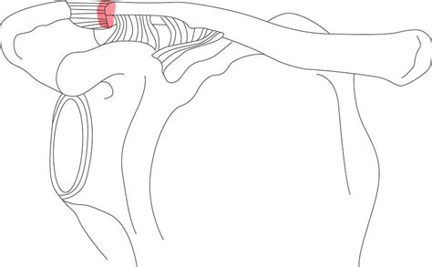 AC Joint Arthroscopic Resection - Shoulder Clinic