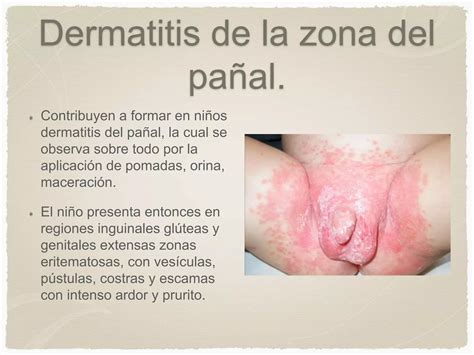 Micosis Superficiales Y Candidiasis Ppt