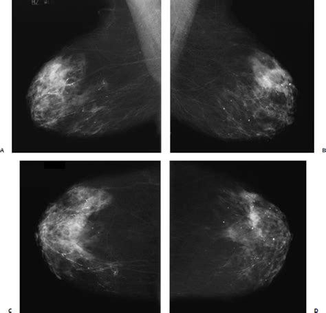 Calcifications Large Linear Radiology Key