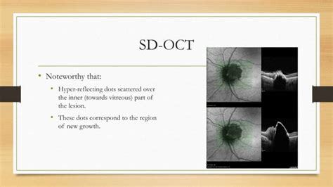 Optic Disc Melanocytoma Ppt