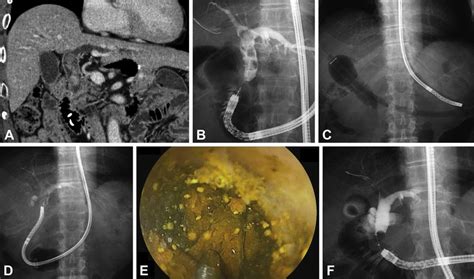 A Coronal Section Of Abdominal Ct Image Showing Multiple Common Bile