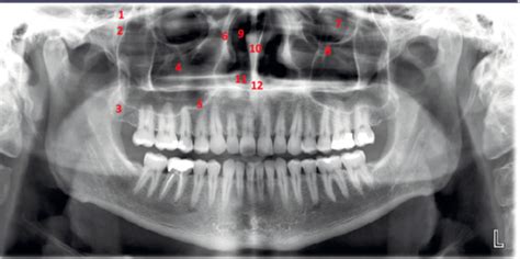 Dental Radiography Structures And Landmarks Flashcards Quizlet