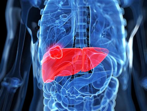 How Lung Cancer Spreads to the Liver