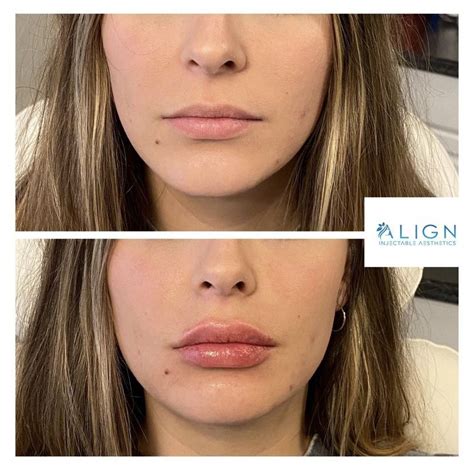 After 1 2ml Of Versa Lip Filler Cosmetic Fillers Facial Fillers Lip