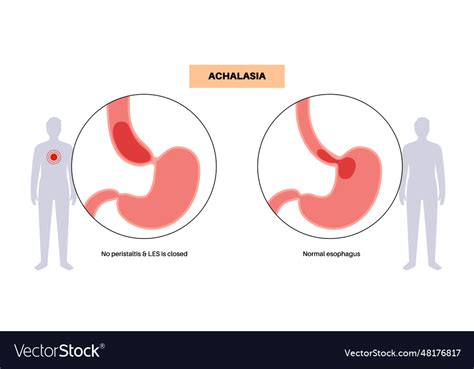 Esophageal Achalasia Disease Royalty Free Vector Image