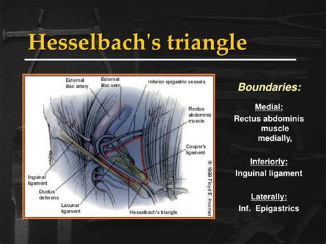 PPT - Inguinal Hernias PowerPoint Presentation - ID:218475