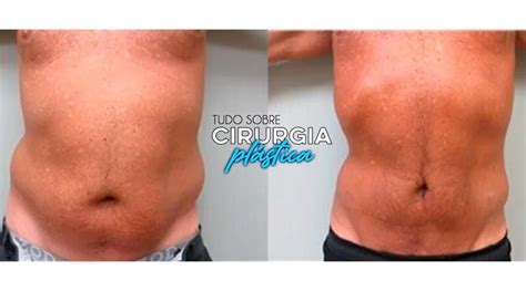 Lipo Valor O que é Antes e Depois Fotos Tudo Sobre Cirurgia