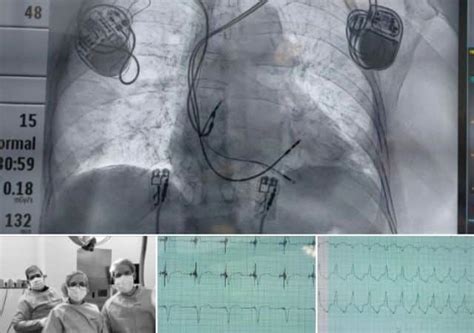 Caso De La Dra Vivien Araya Utilizando Synchromax Synchromax