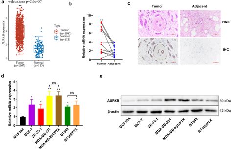 Analysis On The Expression Of Aurkb In Breast Cancer Tissues And Cells