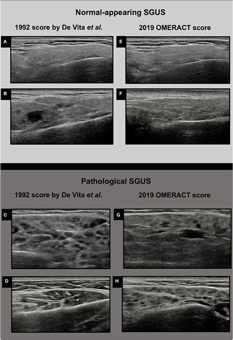 Parotid Gland On Ultrasound