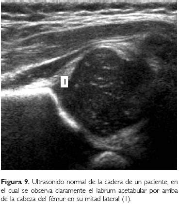 Ultrasonido ortopédico de la cadera infantil