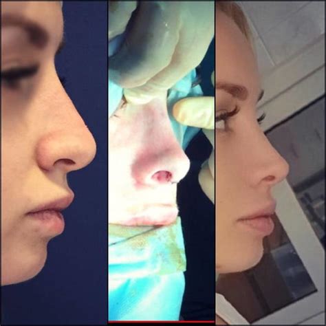 Before And After Wide Nose Jobs Rhinoplasty Cost Pics Reviews Q A