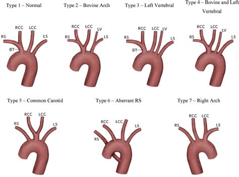 A Systematic Review And Meta Analysis Of Variations In Branching Patterns Of The Adult Aortic