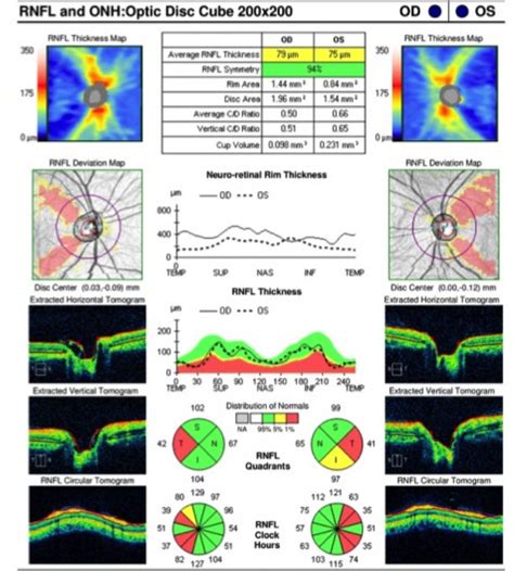 Autosomal Dominant Optic Atrophy Eyewiki