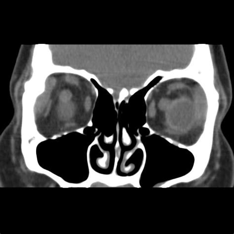 Dermoid Cyst Of The Lacrimal Gland Image