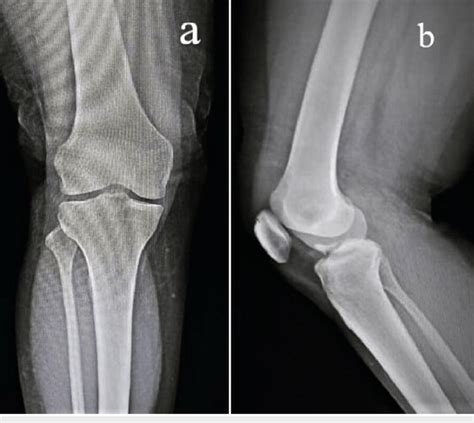 Radiograph Of The Left Knee In Ap A And Lateral B Views With