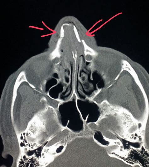 Face Ct Scan Shows Fractures Of The Nasal Bones In A Patient Who