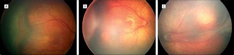 Figure 3 From The International Classification Of Retinopathy Of Prematurity Revisited