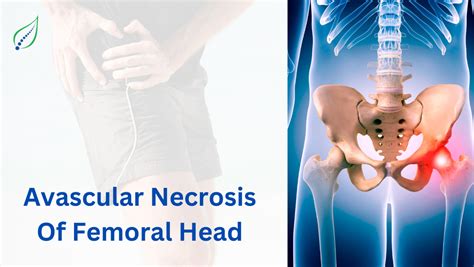 Avascular Necrosis Of Femoral Head Causes Symptoms Treatment Best