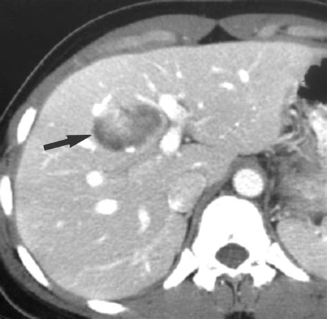 Hepatic Hemangioma Atypical Appearances On Ct Mr Imaging And