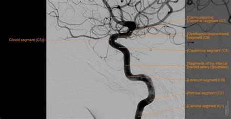 Arteries Of Brain Angiography Normal Anatomy E Anatomy