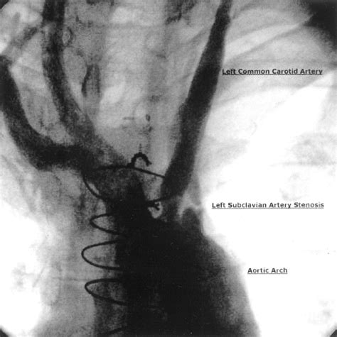 Proximal Subclavian Artery Stenosis Diagnosis And Repair Documented By Both Myocardial Perfusion