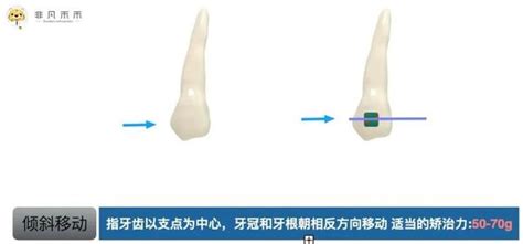 正畸生物力学知识——牙齿移动类型 知乎