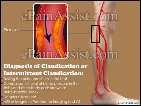 Diagnosis And Treatment For Claudication Or Intermittent Claudication