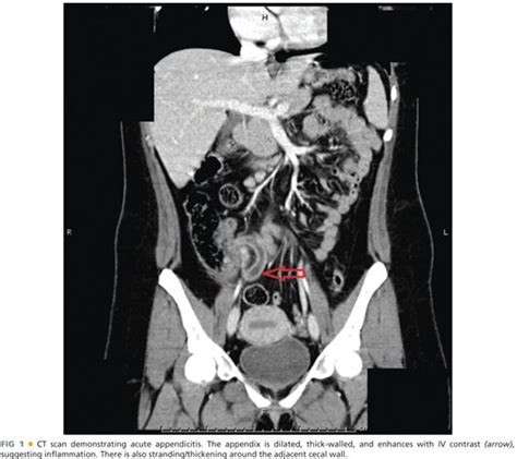 Appendectomy: Single-Incision Laparoscopic Surgery Technique ...