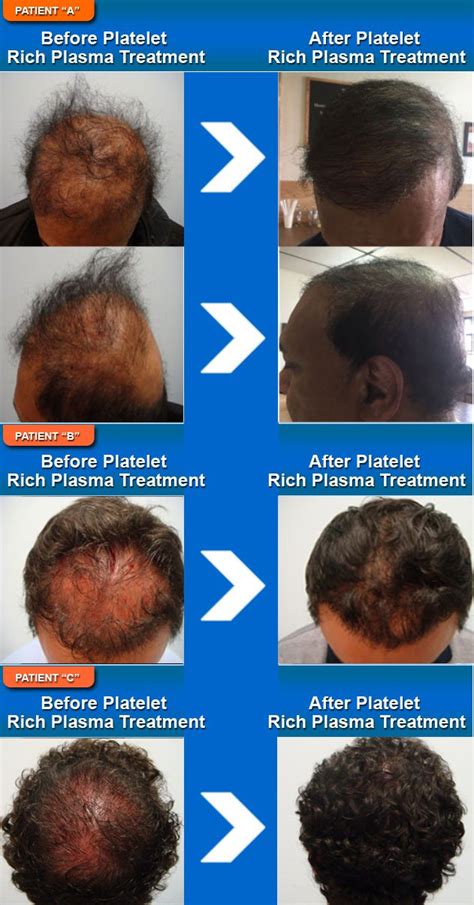 Platelet Rich Plasma Treatment Toronto Sure Hair International Hair