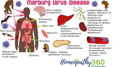 Marburg Virus Disease Risk Factors Stage Signs Symptoms Causes And