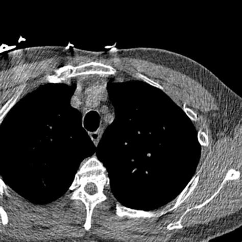 Thorax Ct Scan