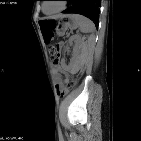 Case 1: 30 YO male patient had a PNB for glomerulonephritis histology... | Download Scientific ...